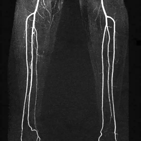 MRI Extremities With Contrast